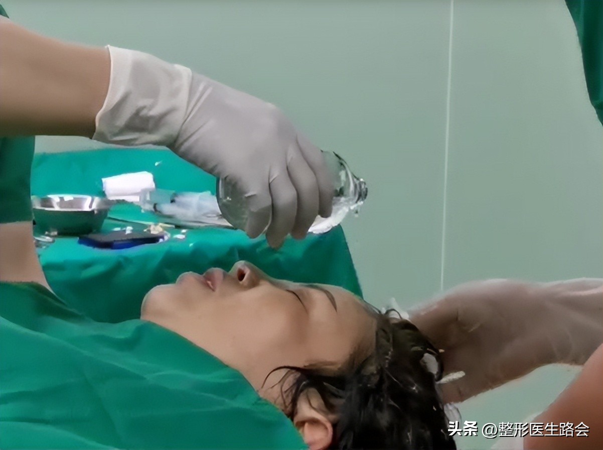 上海九院膨体填充太阳穴费用多少,膨体丰太阳穴视频全过程