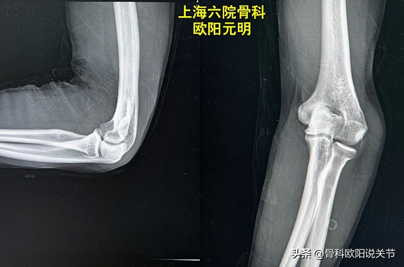 肘内翻能治什么病,肘内翻哪个医生做的好