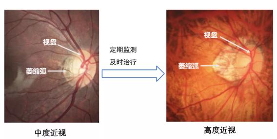 高度近视眼底黄斑病好治吗,高度近视检查眼底就行了吗