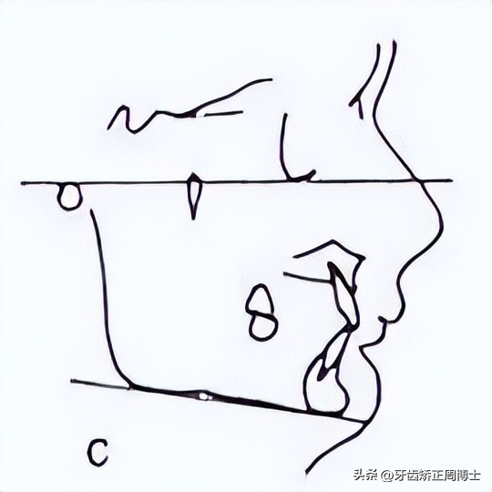低角面型下巴前倾正畸案例,露龈笑嘴凸下巴后缩
