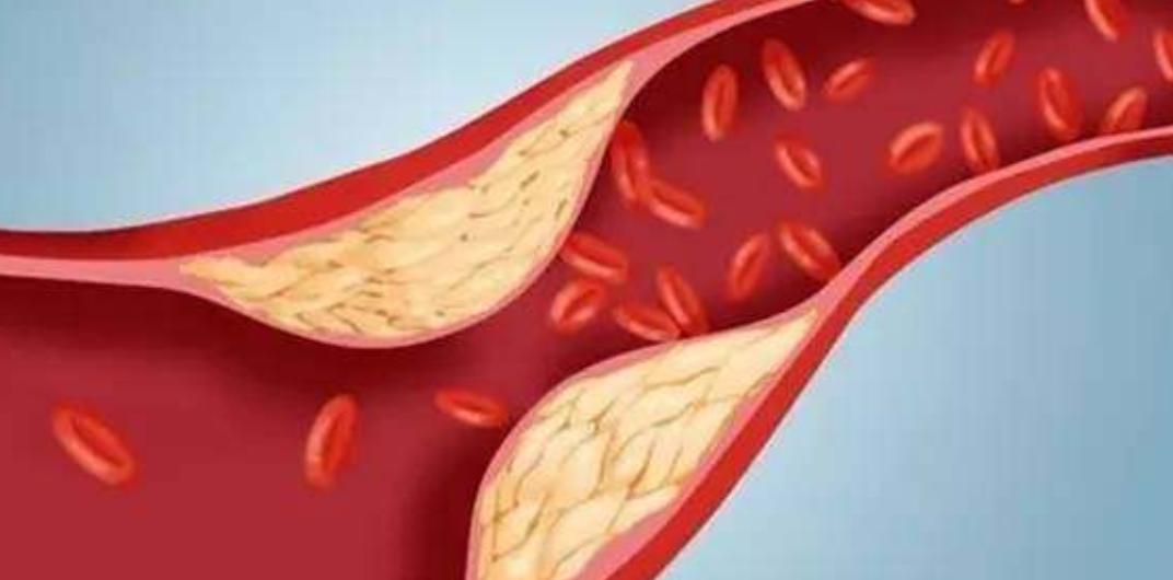 血管堵不堵劝你及时做好4件事,血管不好血难抽如何改善血管