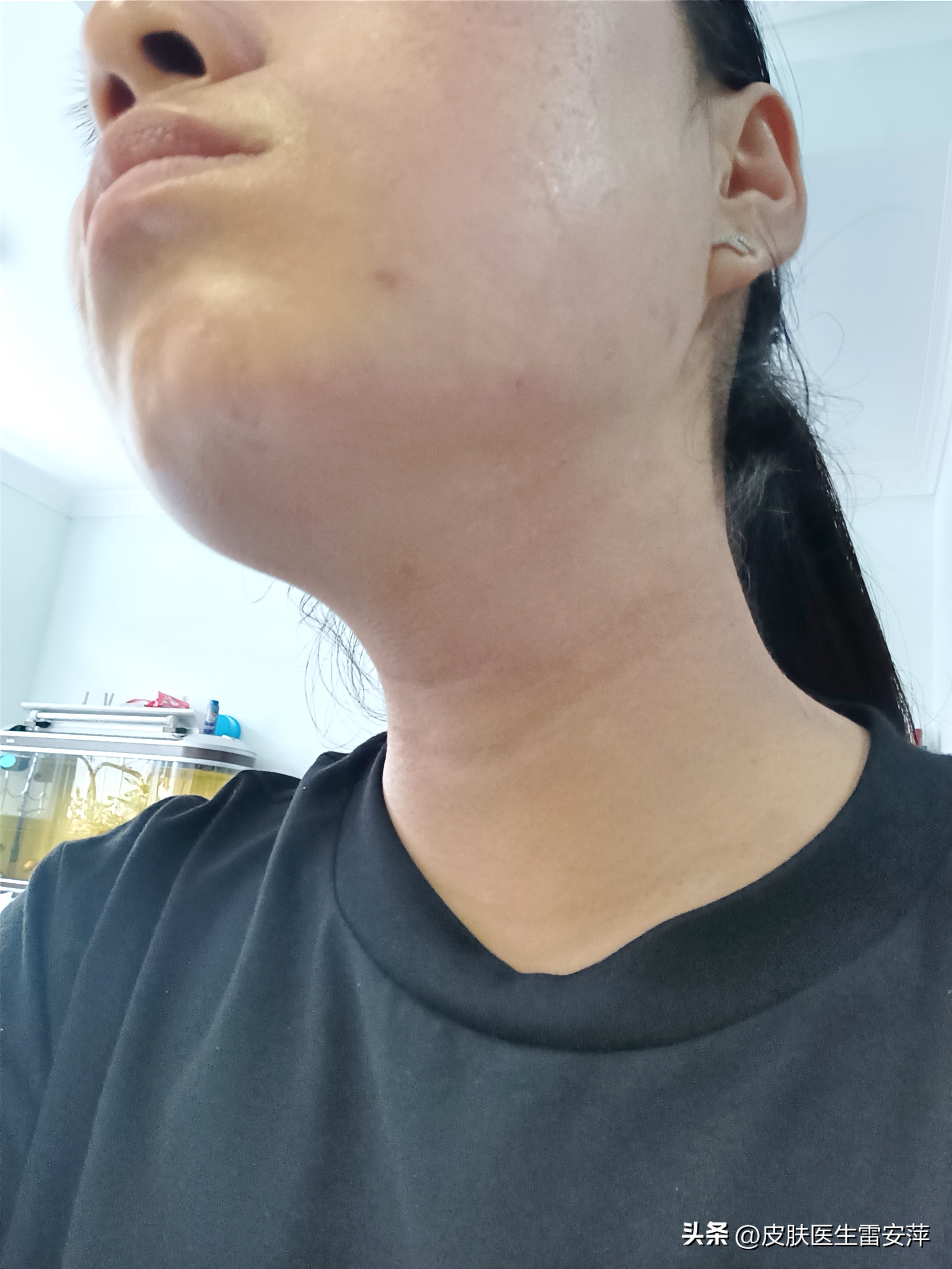 茄子治疗白癜风治好的几率是多少,儿童白癜风治好的几率有多大