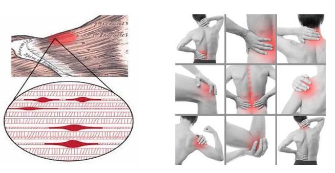 如何解决跑步膝,膝盖筋膜受损多长时间可以跑步