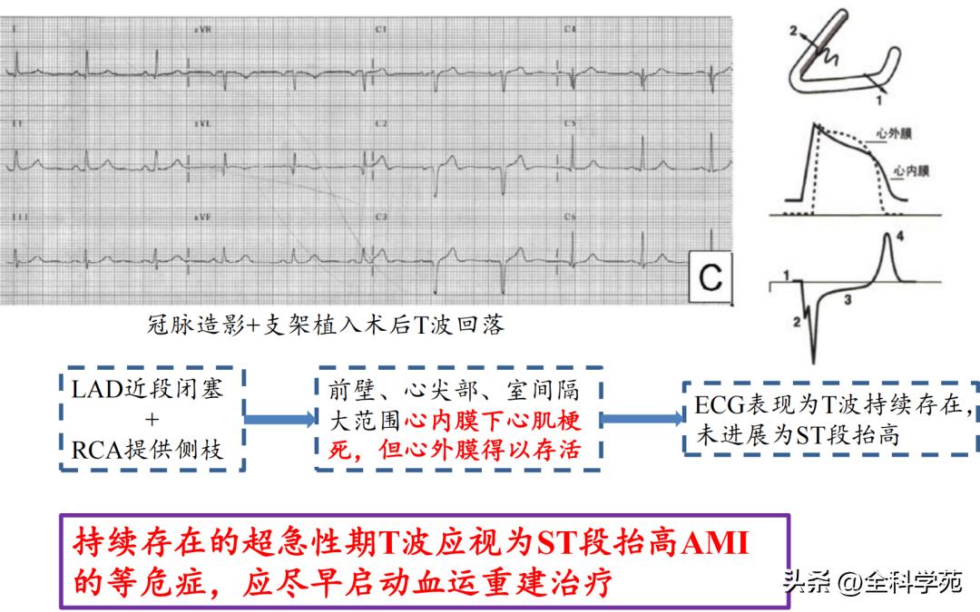 t波高尖心电图判断标准,t波高尖判断标准