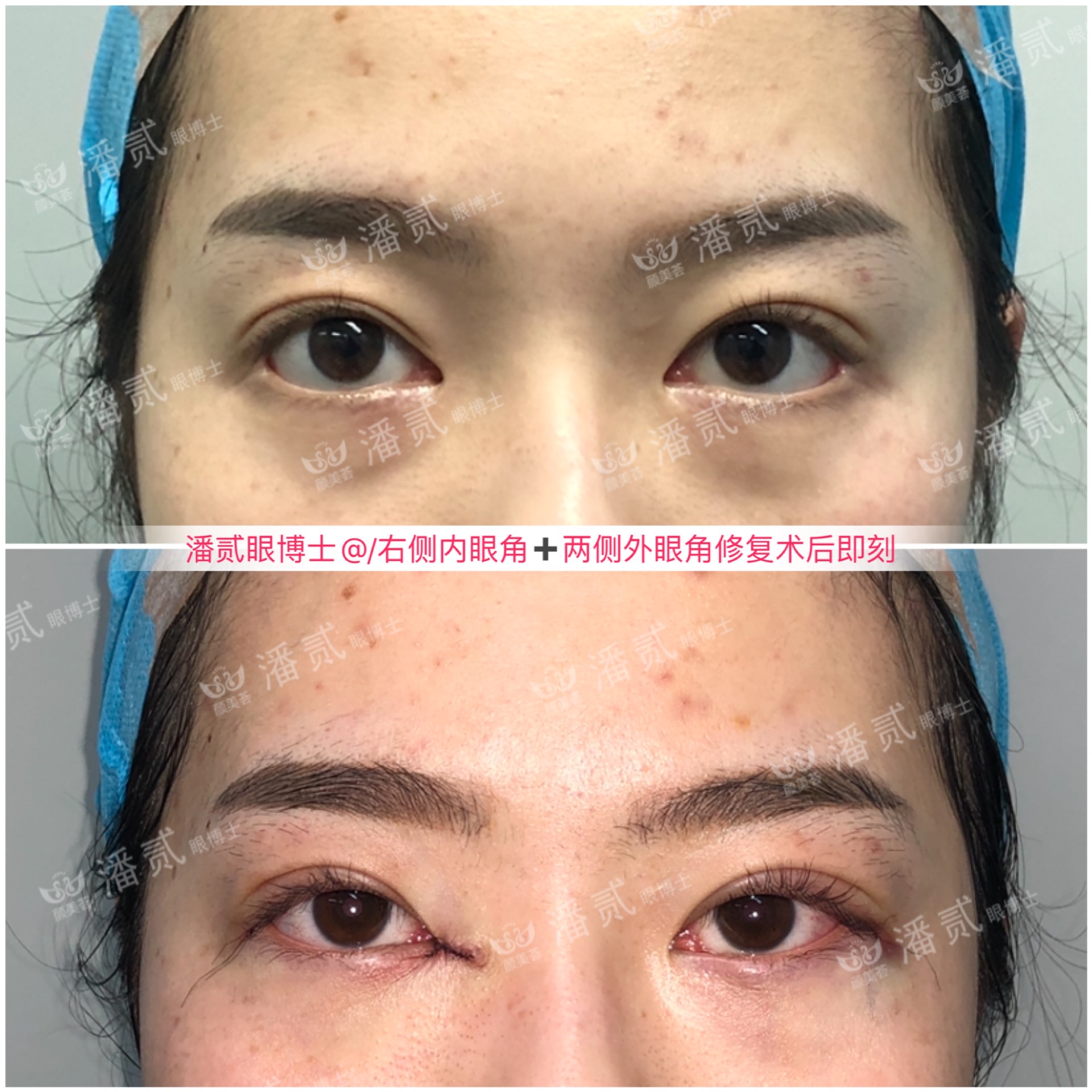 成都女子整容失败眼睛失明后续,整容眼角失败案例