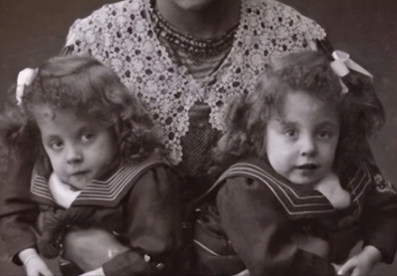 连体人一方死亡怎么办？妹妹去世后，连体姐姐被迫跟遗骸共同生活