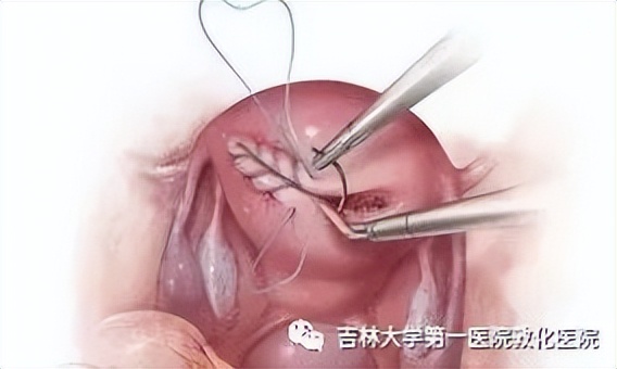 海扶刀很好吗,海扶刀为啥叫海扶刀