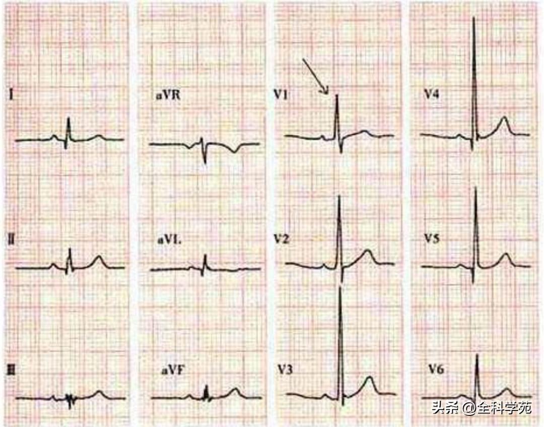 心电图笔记26：QRS波振幅变高，需要想到哪些