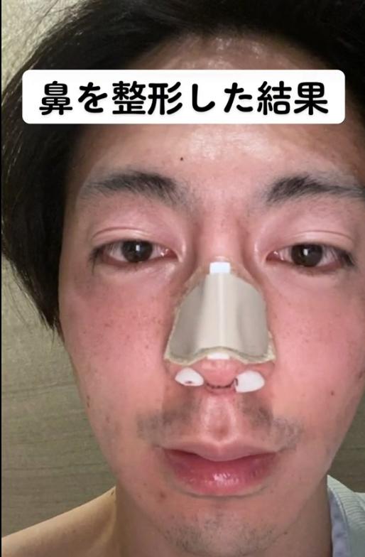 日本1米5小哥砸1600万疯狂整容增高！断骨惨烈过程吓傻网友