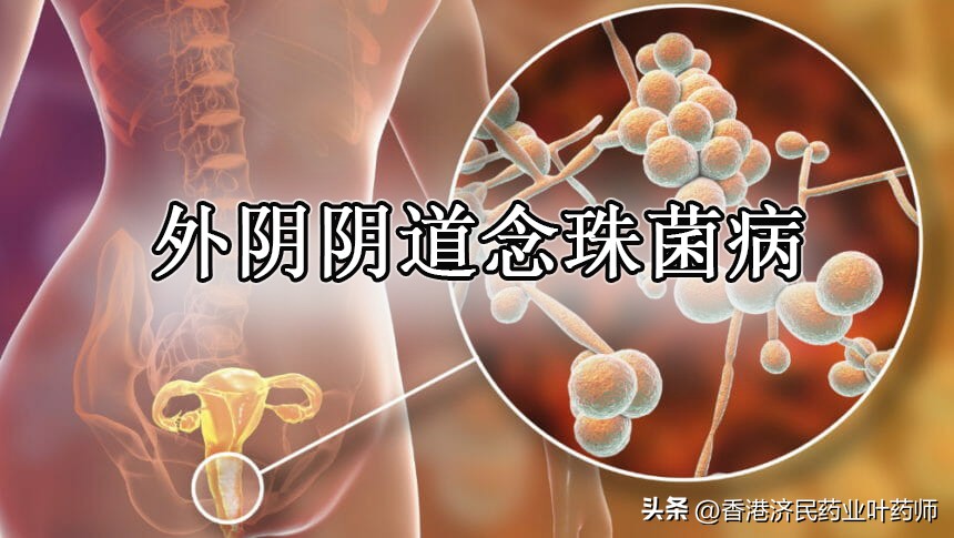 念珠菌性外阴炎怎么预防,复发性外阴念珠菌怎么治疗最好