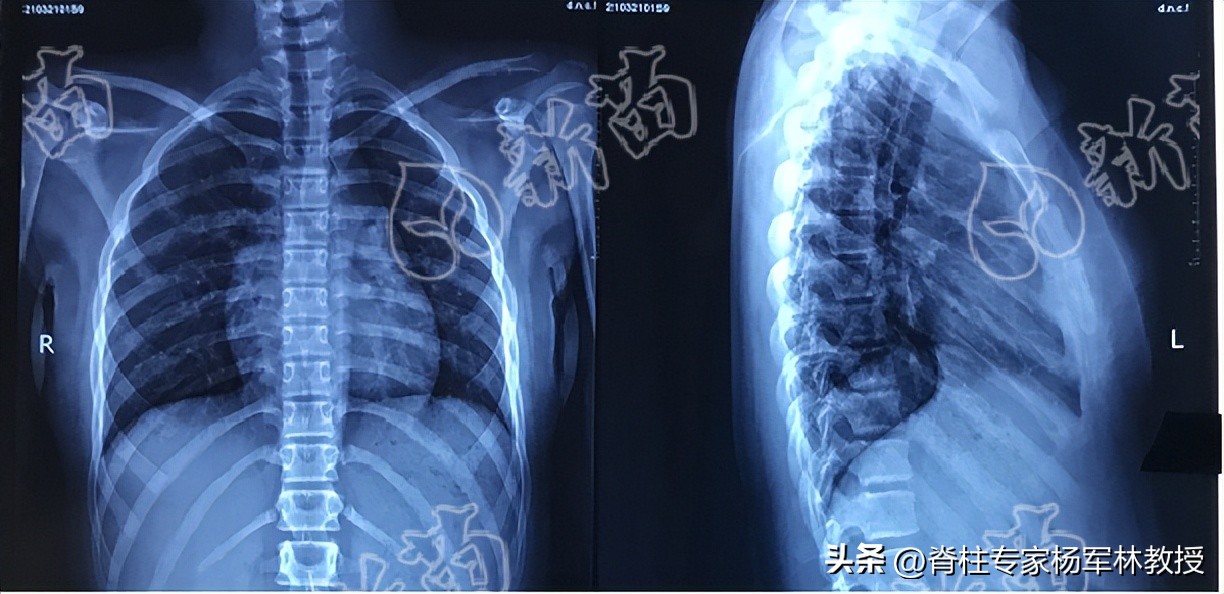 x光片不清晰是拍摄人员的问题吗,x光片可能会拍错吗