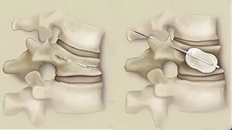 打个喷嚏导致腰椎骨折视频,打个喷嚏全身骨折视频