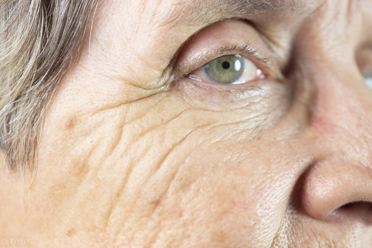 如何才能淡化脸部刚开始的老年斑,脸和手都长老年斑是怎么回事