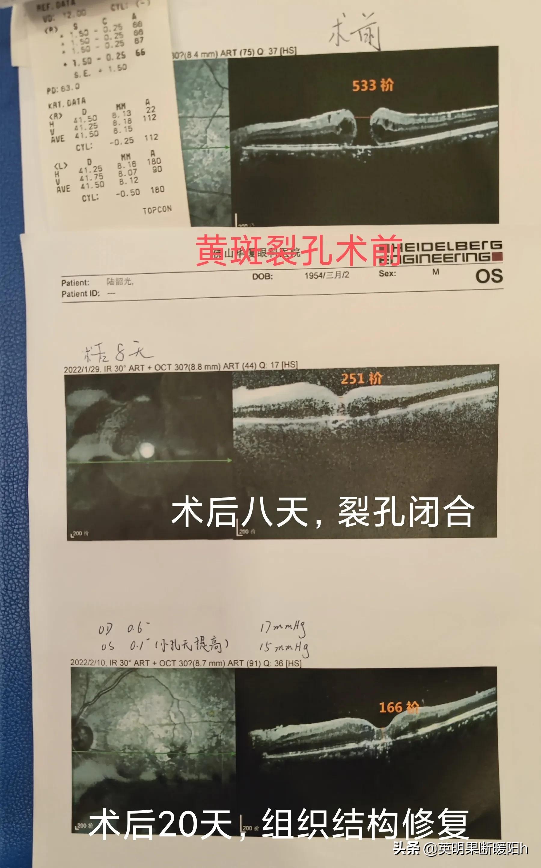 眼睛黄斑裂孔中医能治好吗怎么治,眼睛黄斑裂孔有什么症状