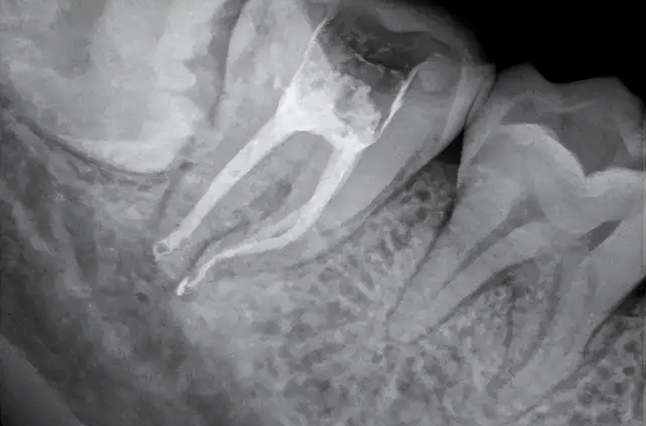 怎样知道牙髓有没有坏死,怎样判断牙髓坏死了