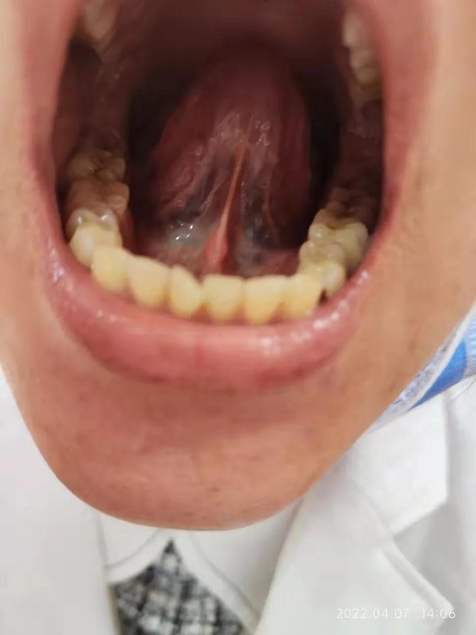 针药并用对发热的治疗效果如何,针药并用好处