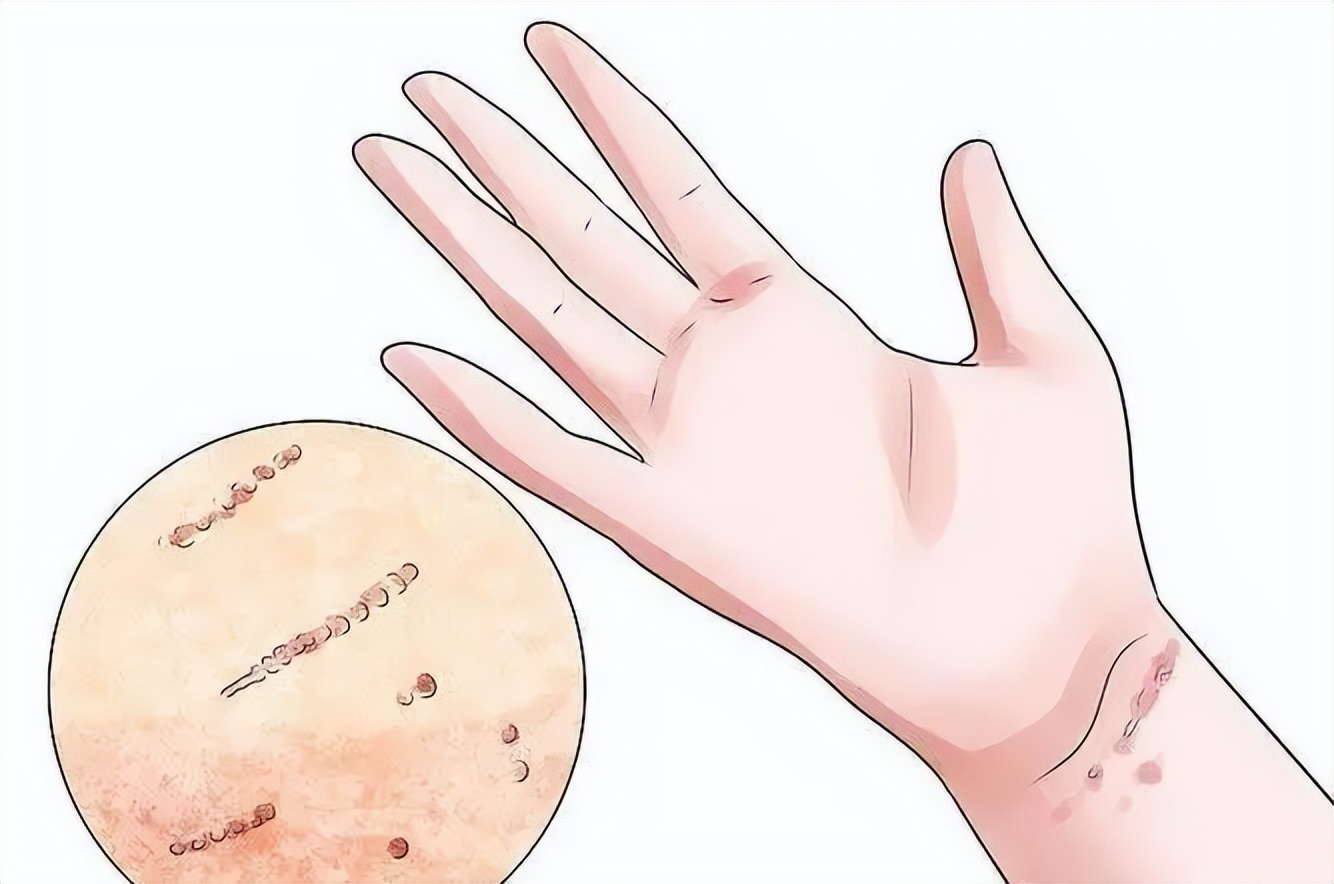 疥疮会引起腹痛吗,灼热疼痛怎么回事