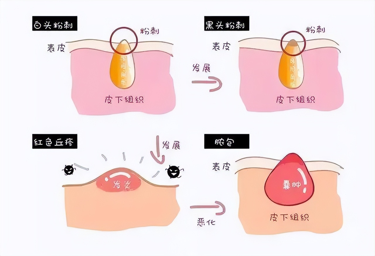 孕期长痘用的护肤品,孕妇长痘可以用祛痘的吗