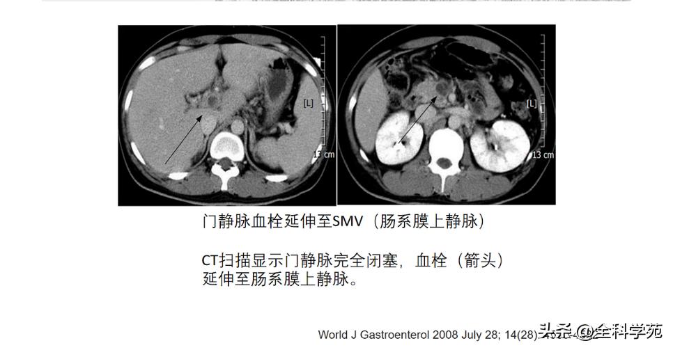 阑尾炎的讲解,关于阑尾炎的讨论总结