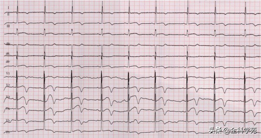 t波倒置三种常见原因,t波低平倒置有事吗