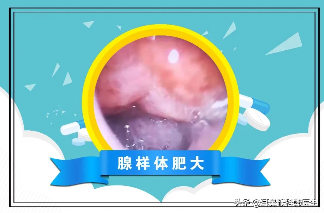 耳鼻喉电子内窥镜能检查哪些问题,硬性耳内窥镜检查疼吗