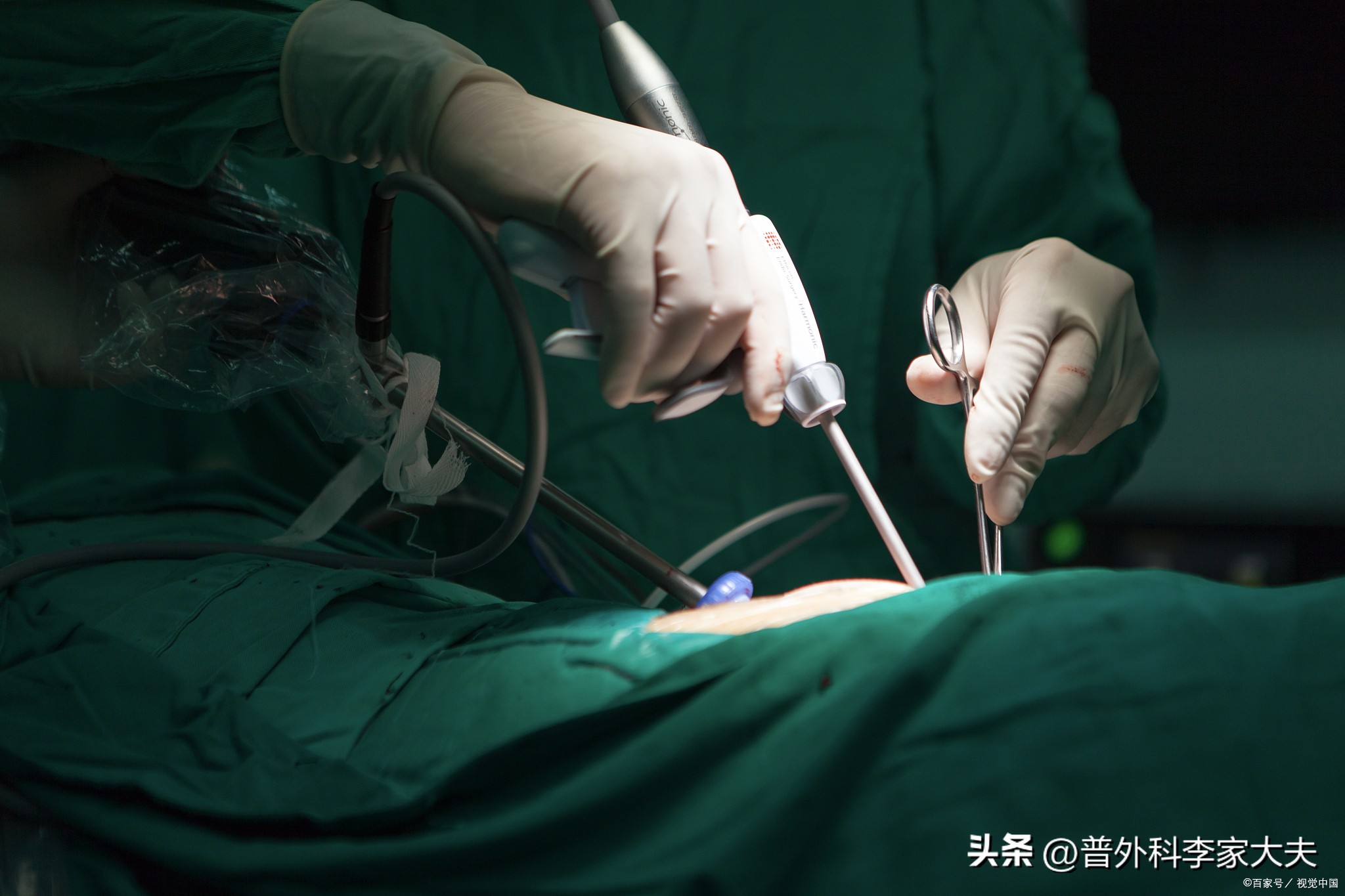 结肠癌肝转移最好的中医是谁,结肠癌肝转移老人抗癌视频