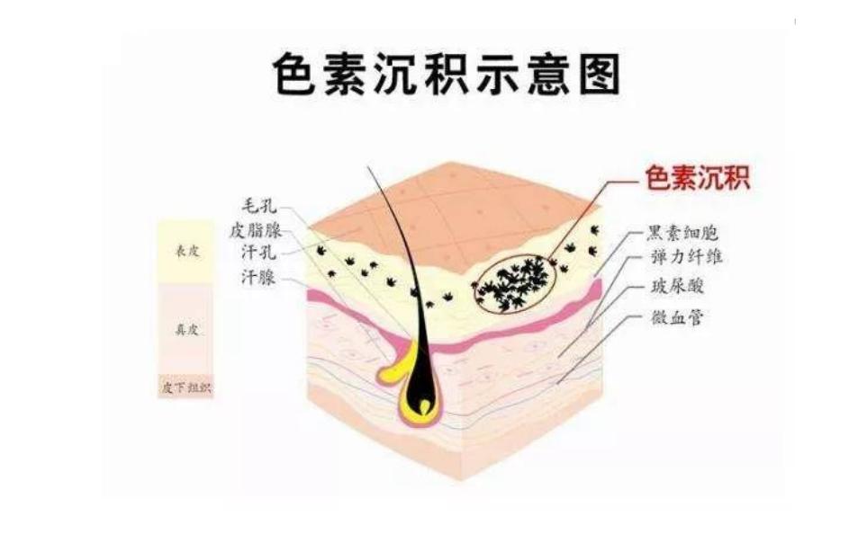 红霉素软膏与姜末祛老年斑有用吗,红霉素软膏能淡化老年斑吗