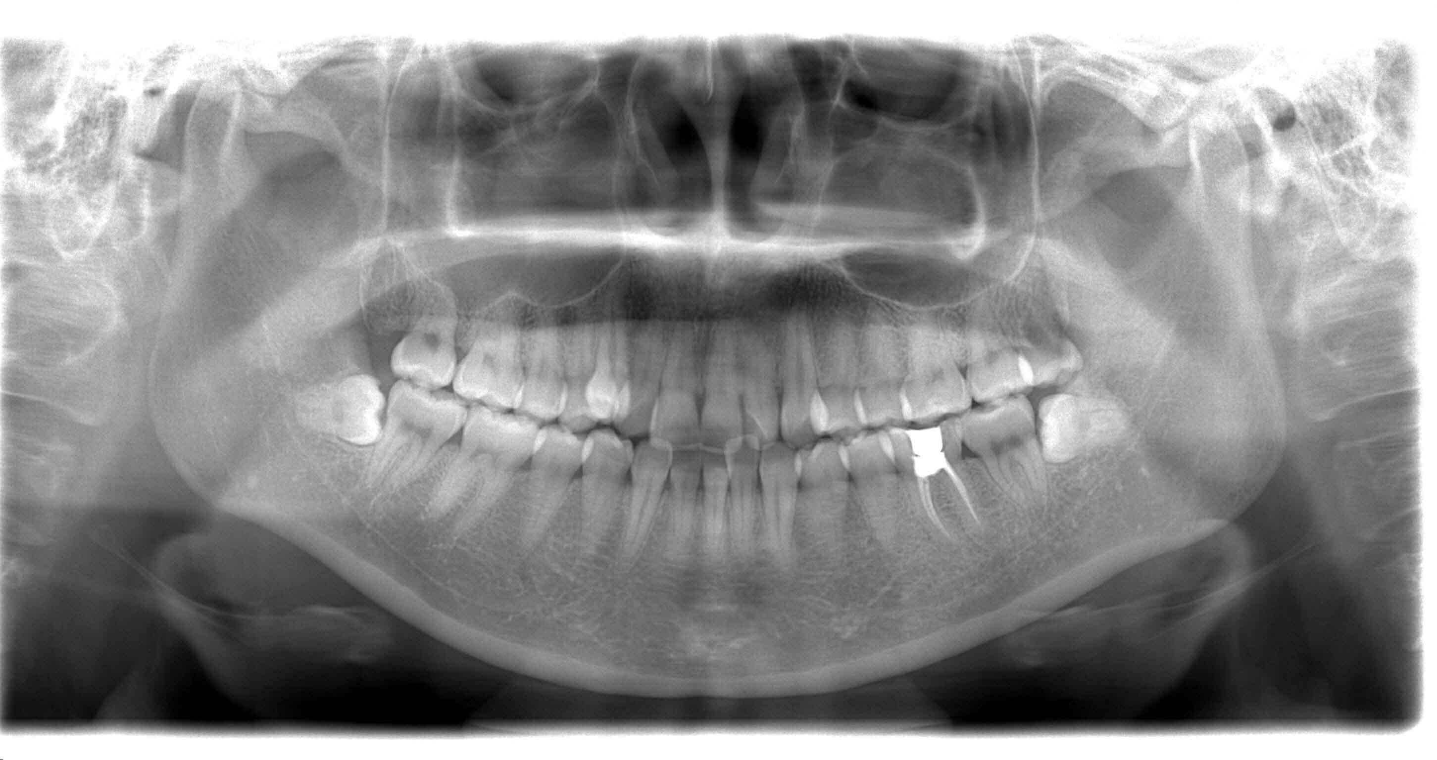 告别牙周炎的烦恼,告别牙痛