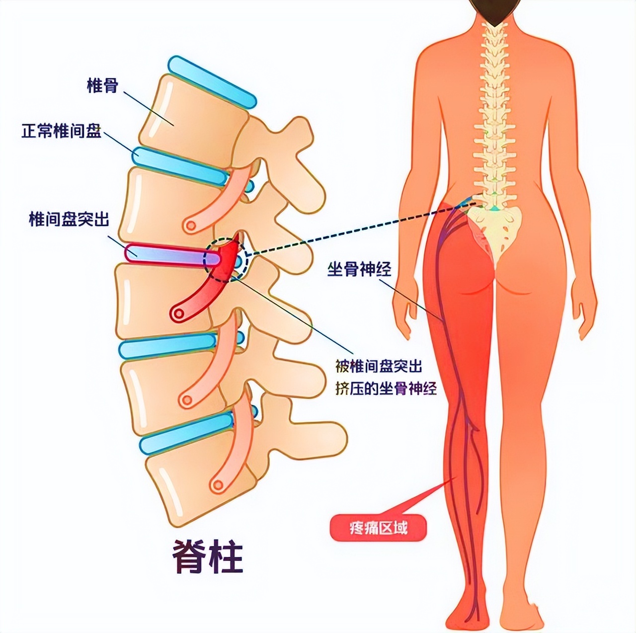 腰痛应该灸哪里,腰痛冷敷还是热敷
