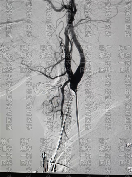 广州中山肿瘤医院喉癌治愈率,广州哪个肿瘤医院治疗喉癌最好