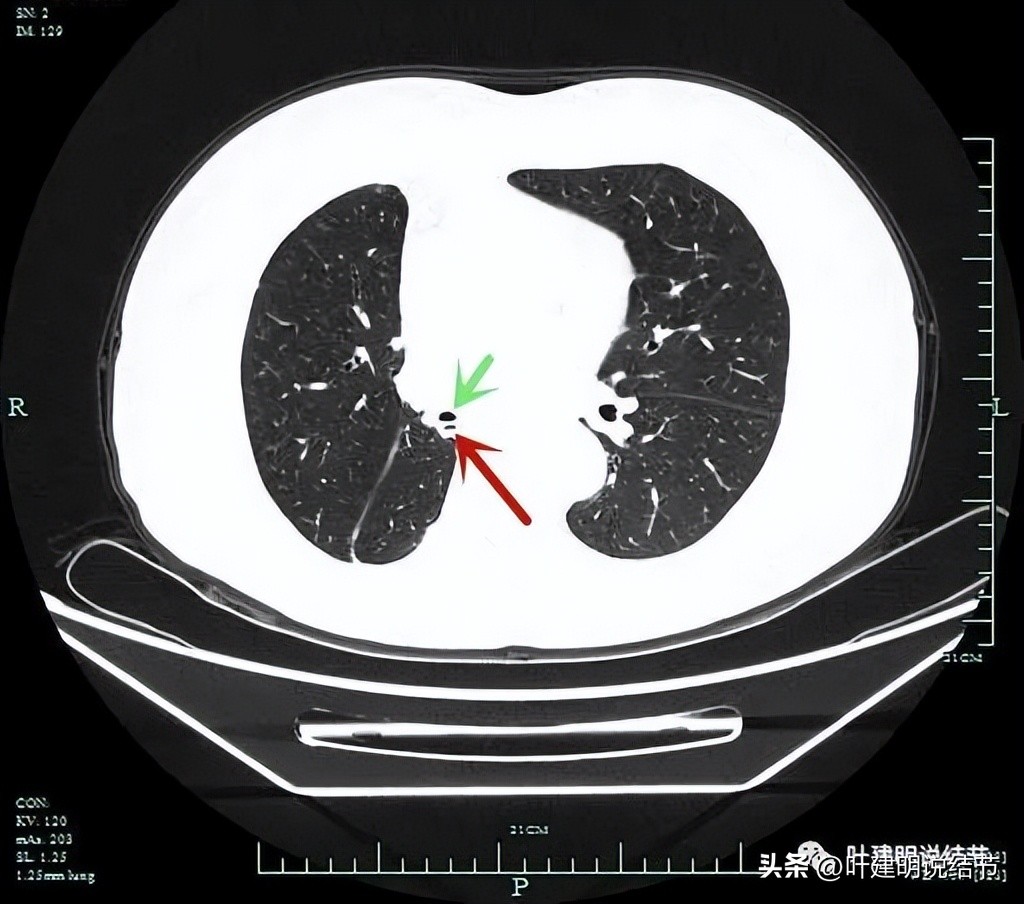 右下叶磨玻璃6mm结节基本上是癌,右下叶少许炎症上叶磨玻璃结节