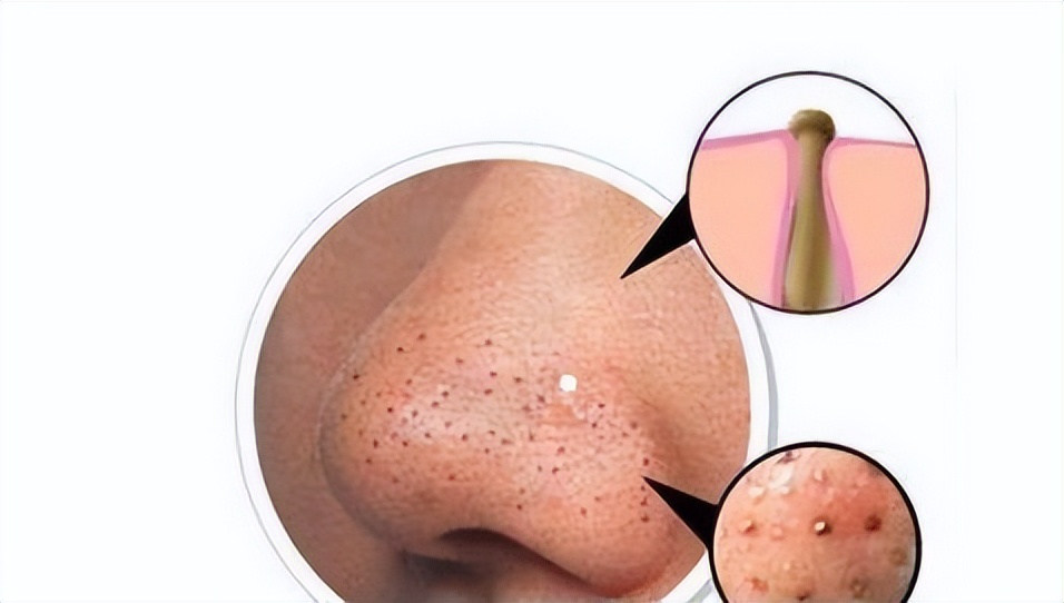 鼻子上挤出白色的是螨虫吗,怎么知道鼻子是螨虫引起的红血丝