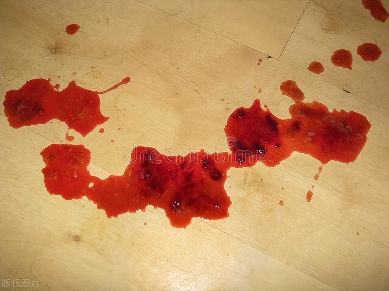 痔疮经常便血会不会有生命危险,痔疮切了还会便血吗