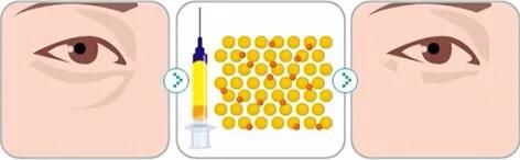 自己怎么修复泪沟,泪沟是消除不了的吗