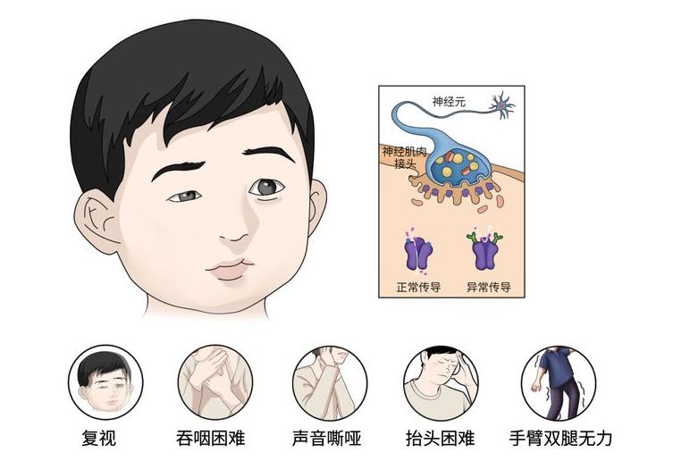 眼皮肿要警惕四种病,眼皮沉重乏力什么原因