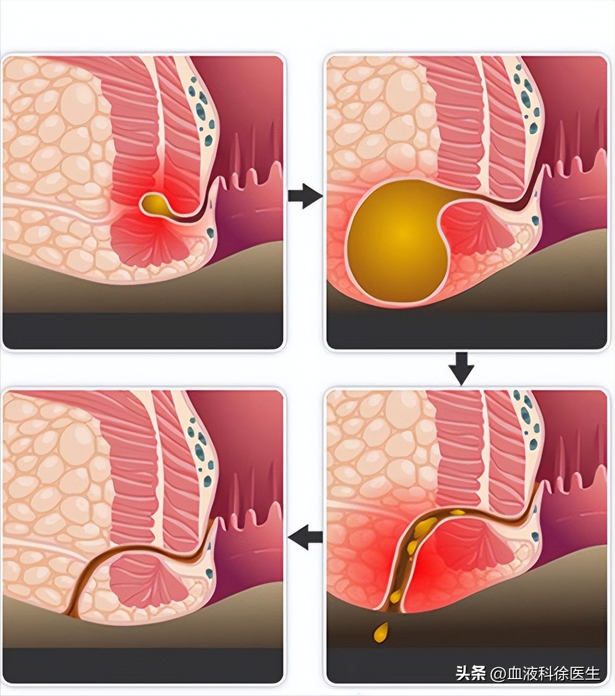 肛瘘手术不彻底医生有责任吗,肛瘘不想手术