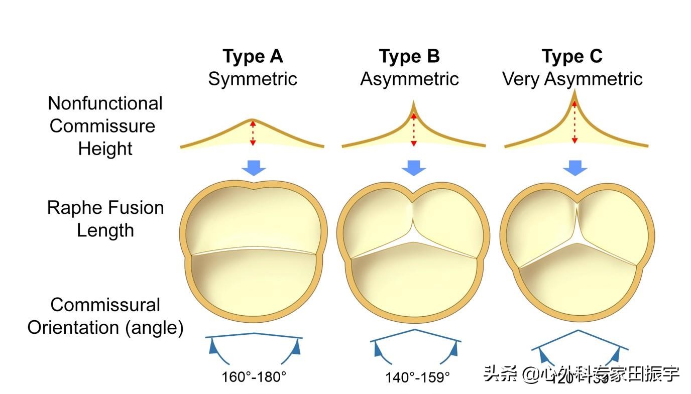 最先进的主动脉瓣二瓣叶畸形修复术（2020版）