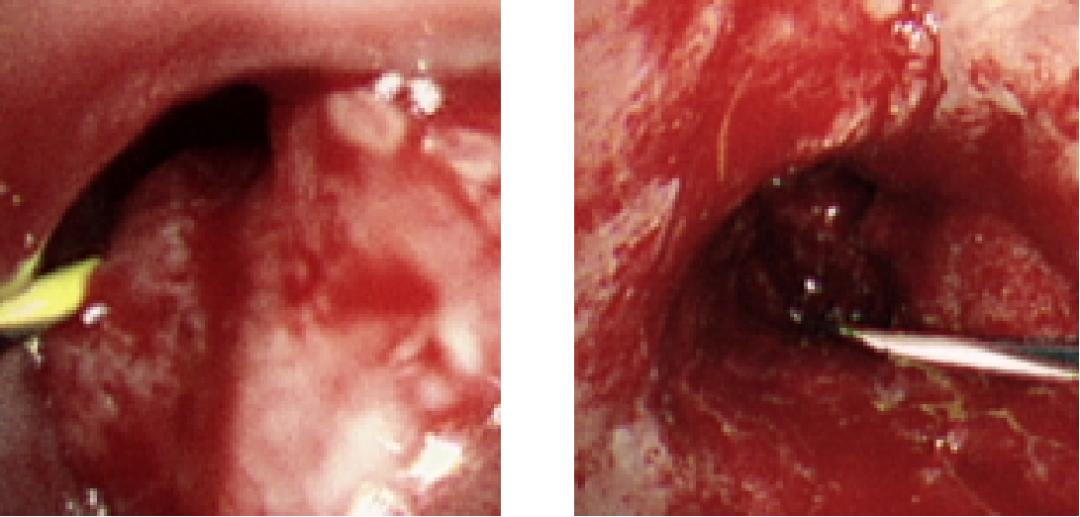 咯血一定要做支气管镜吗,支气管镜的注意事项