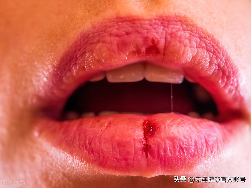 经常舔嘴唇导致嘴唇干怎么办,嘴唇干越舔越干怎么回事