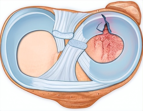 半月板保护用护膝还是髌骨带,半月板是消耗品吗