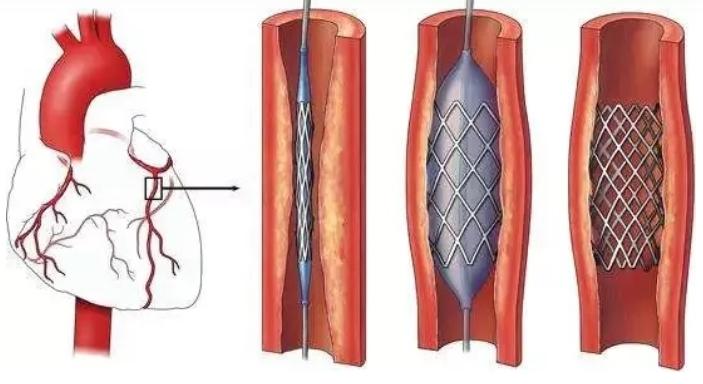 血管狭窄75%以上就要放支架么？放了支架就好了么？
