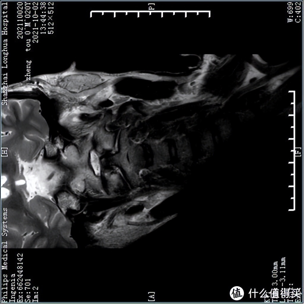 颈椎病睡记忆枕管用吗 (记忆枕对颈椎病有效)