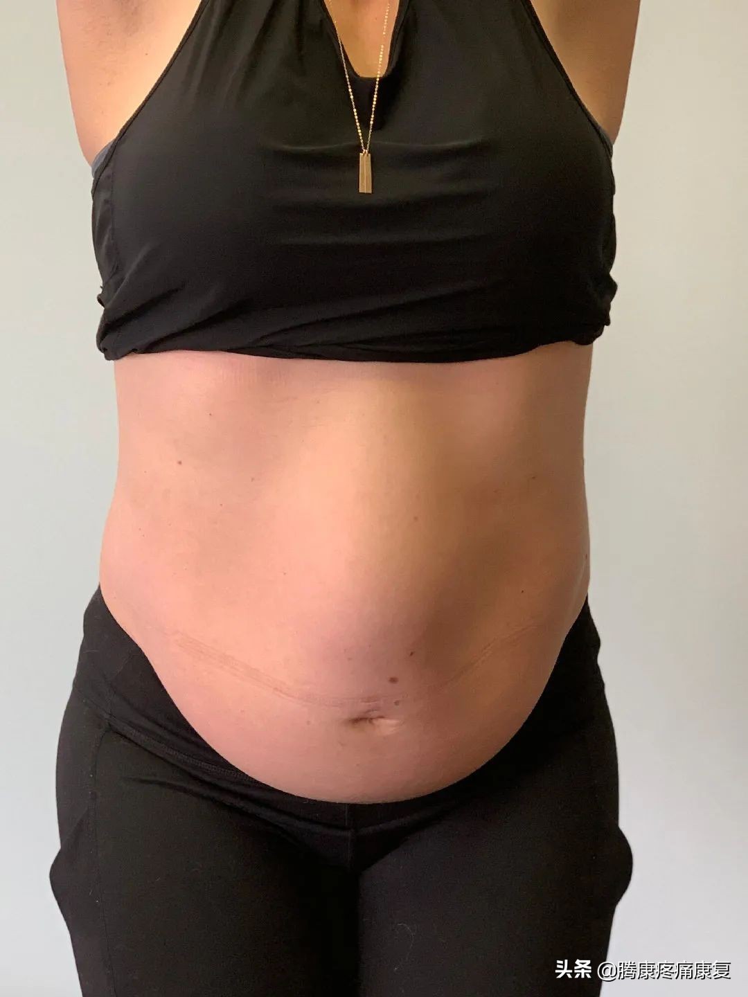 产后腹直肌分离康复训练方法,腹直肌分离的康复动作