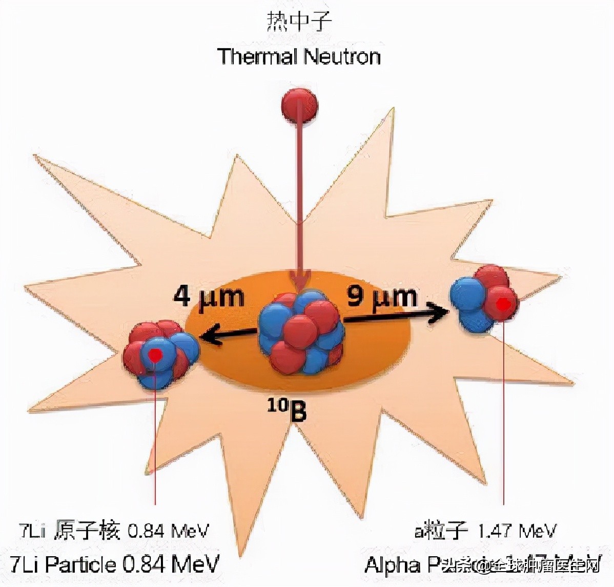 日本硼中子俘获疗法治愈癌症晚期,日本硼中子治疗癌症最新进展