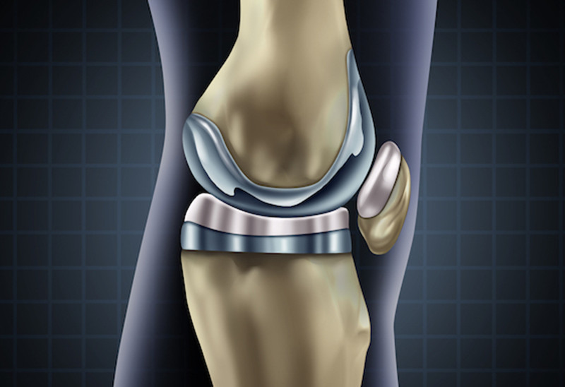 换了人工膝关节很痛苦是吗,人工膝关节换后十五年后怎么办