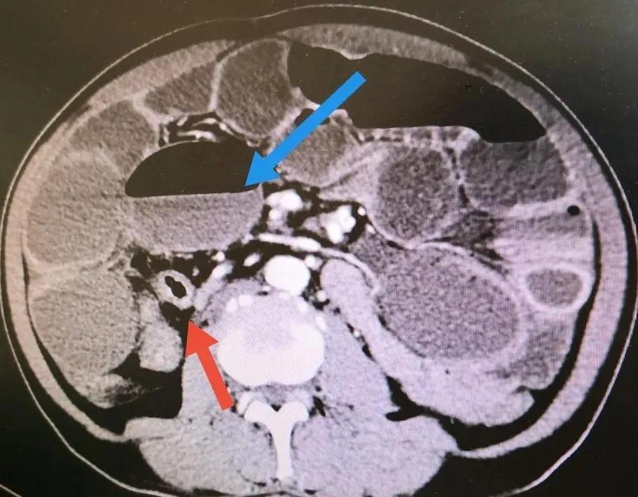 腹腔镜下结肠癌根治术,腹腔镜下结肠癌根治术手术步骤