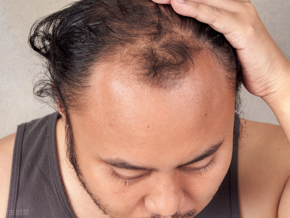 为什么越来越多人备受脱发困扰,如何解决大量脱发