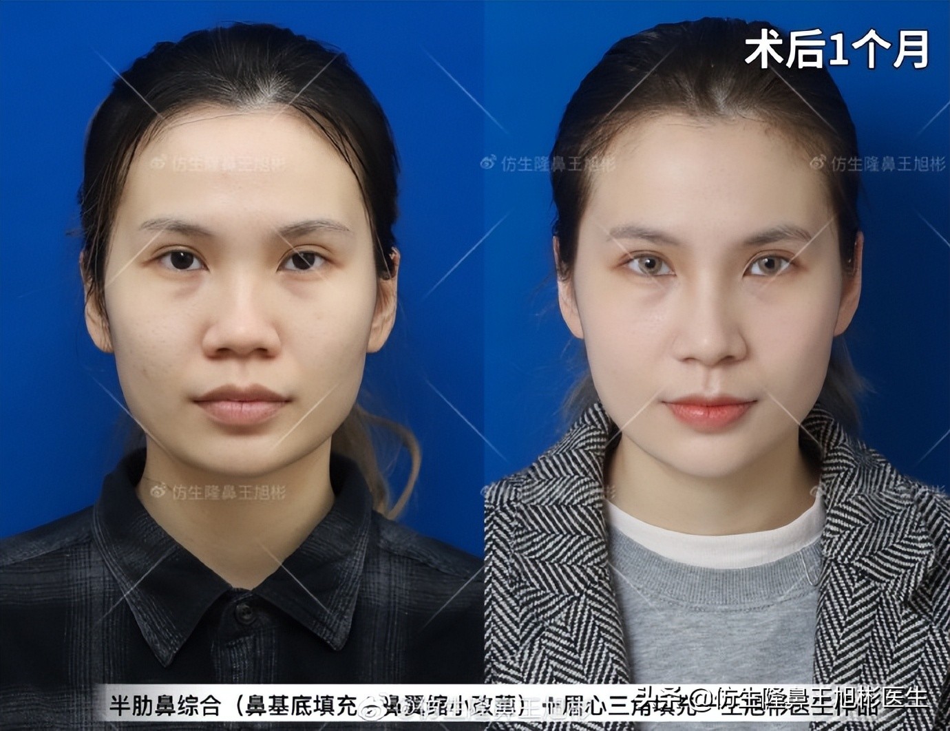 可以只做鼻头不放假体吗,只做鼻头鼻翼缩小手术多少钱