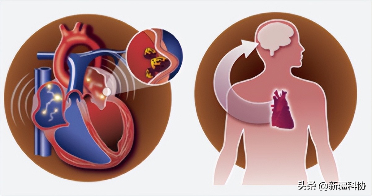 心律失常一定要采用射频消融吗,心律失常射频消融术哪里做得好