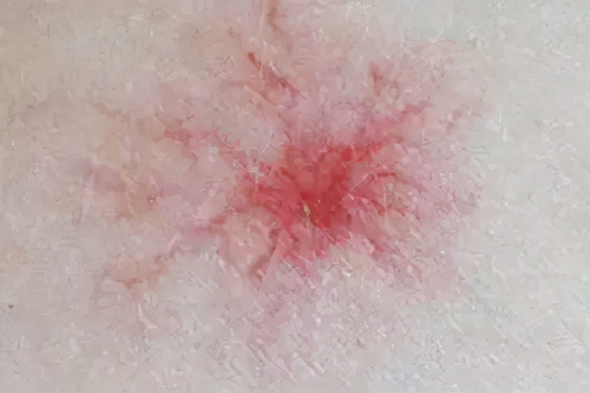 身上出现小红点是怎么回事没感觉,身上出现大面积小红点不痛不痒的